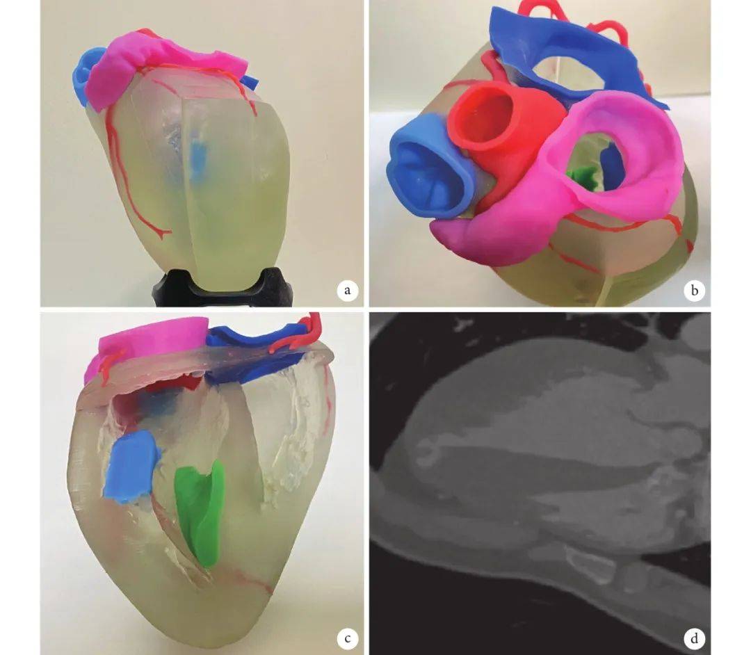 患者心脏3D打印模型及CT图像