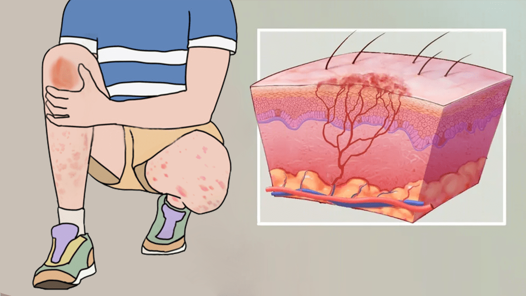 过敏性紫癜会导致脑部血管损伤吗?