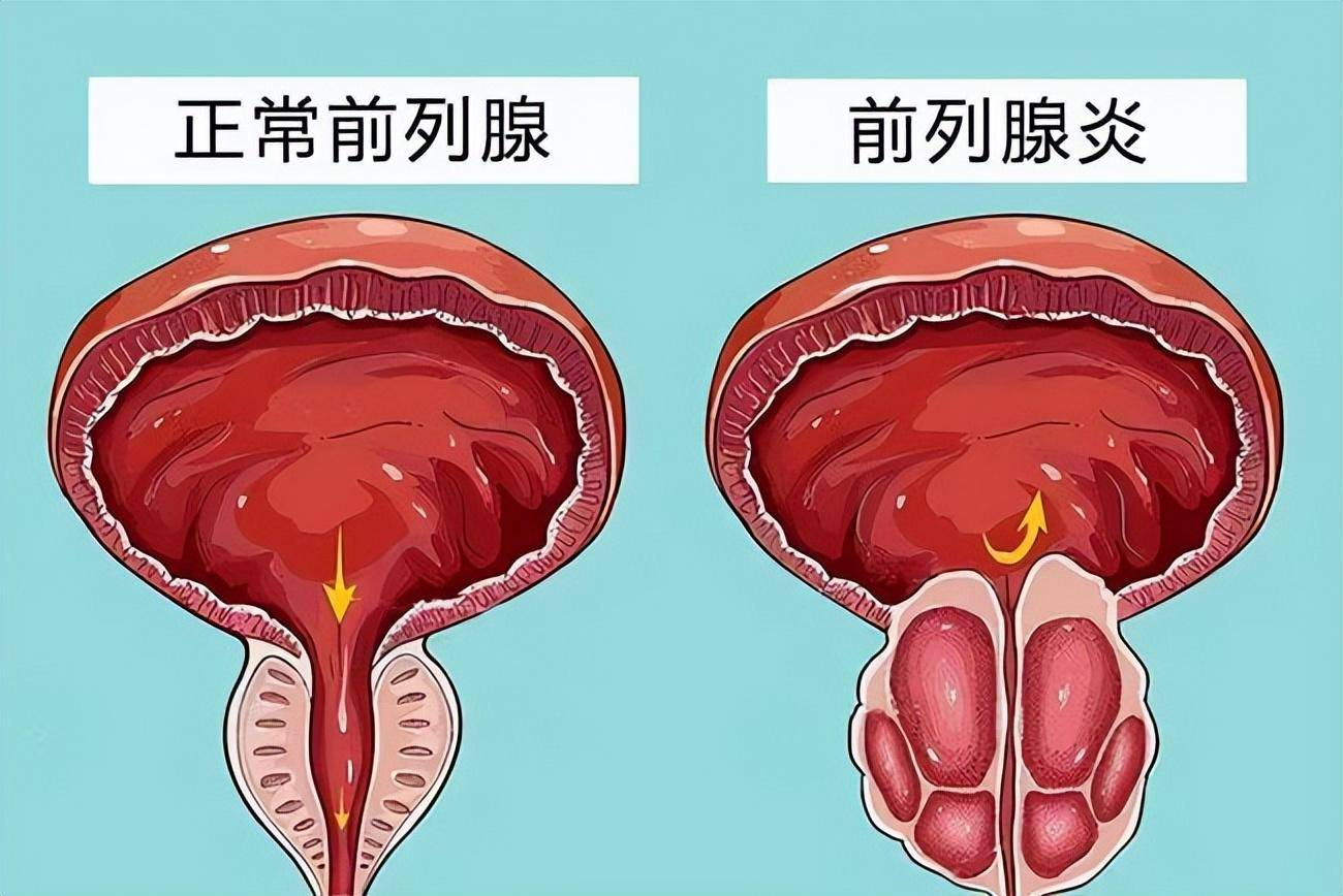 慢性非细菌性前列腺炎(也称为慢性盆腔疼痛综合征):病因不明,没有