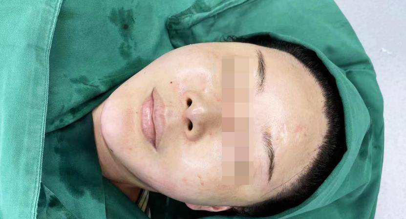 注射数百玻尿酸寻求整容手术修复_袁博_效果_医生