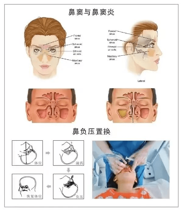 鼻窦开口位置口诀图片