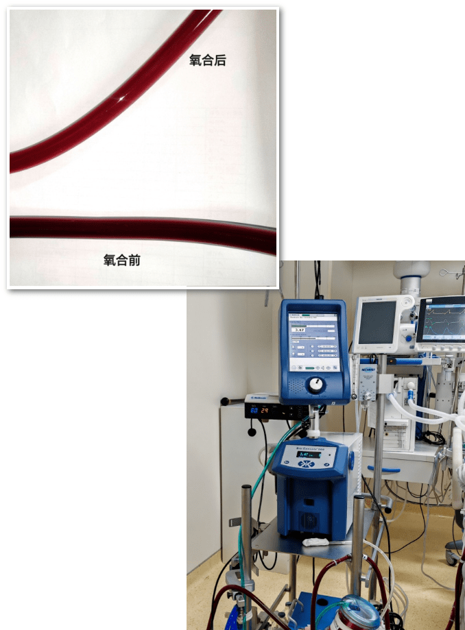 急诊科 重症医学ecmo团队体外膜肺氧合(extracorporeal membrane