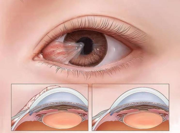 眼睛盖上了"纱窗"——翼状胬肉_手术_角膜_视力