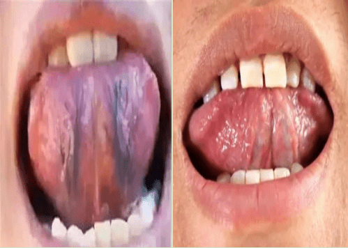 健康的舌根青筋的图片图片