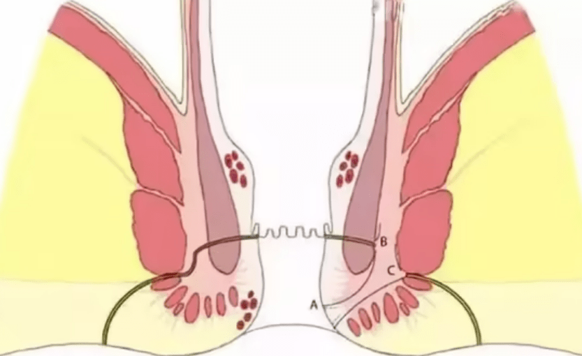 痔疮是由于肛门静脉曲张而引起的一种疼痛和不适感
