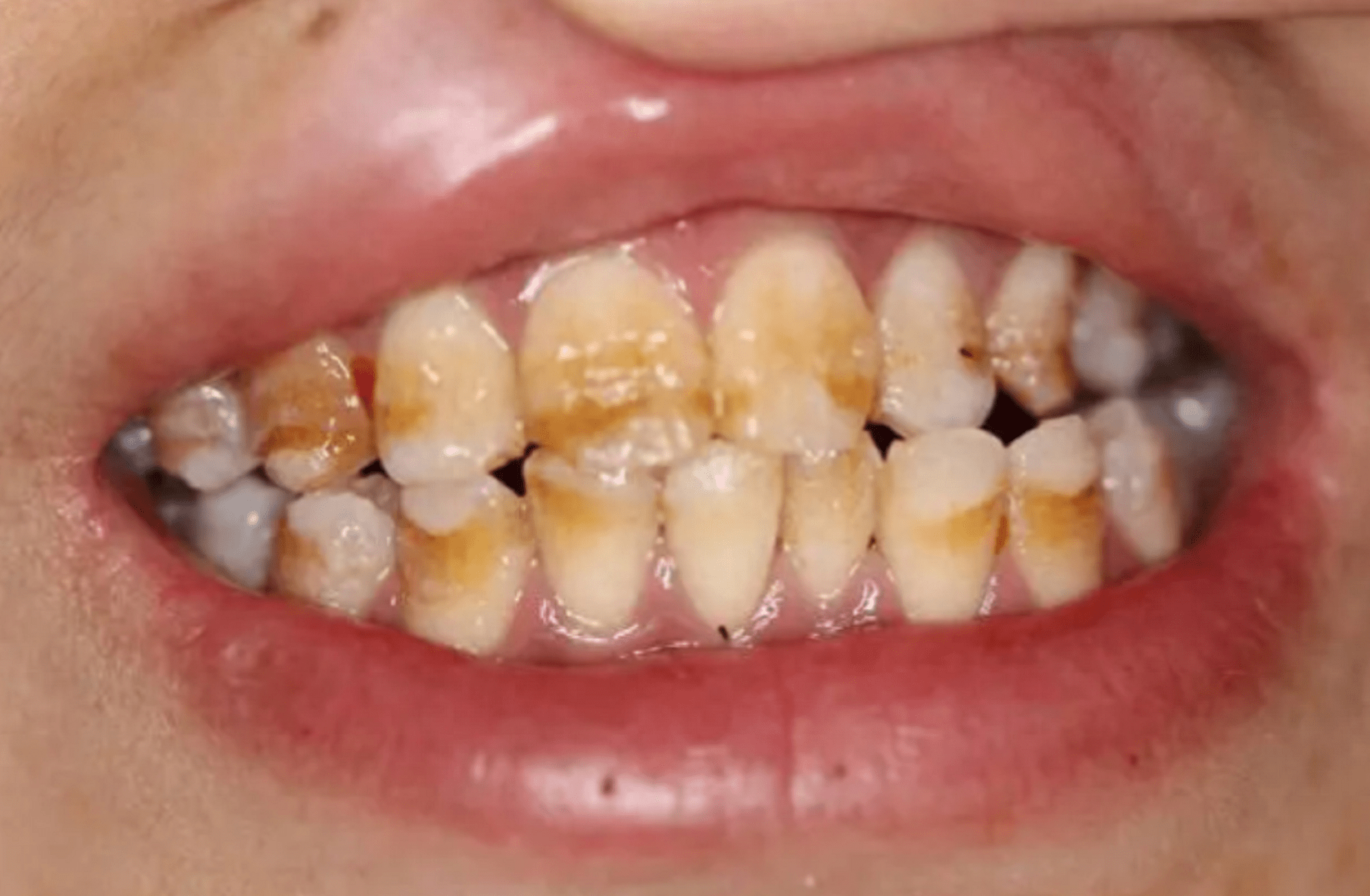 最有效的牙渍去除小妙方!刷掉陈年老污渍,牙齿瞬间亮白两个度!