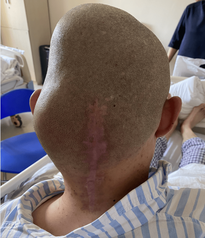 小伙被巨大罕见脑瘤"缠身"三博专家背水一战,向高难度手术亮剑_小郑