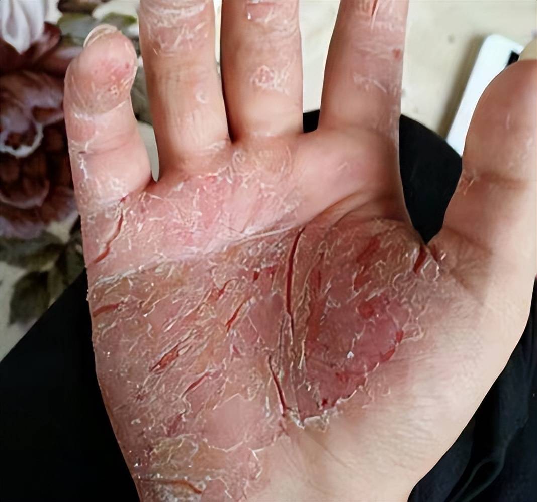 或许是方法没用对,这样做才能彻底搞定!_皮肤_效果_裂口