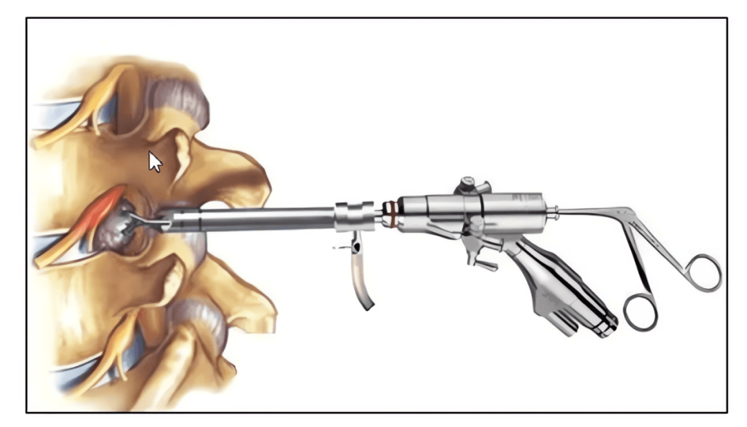 腰椎间盘突出症的手术治疗 手术适应症与术后护理