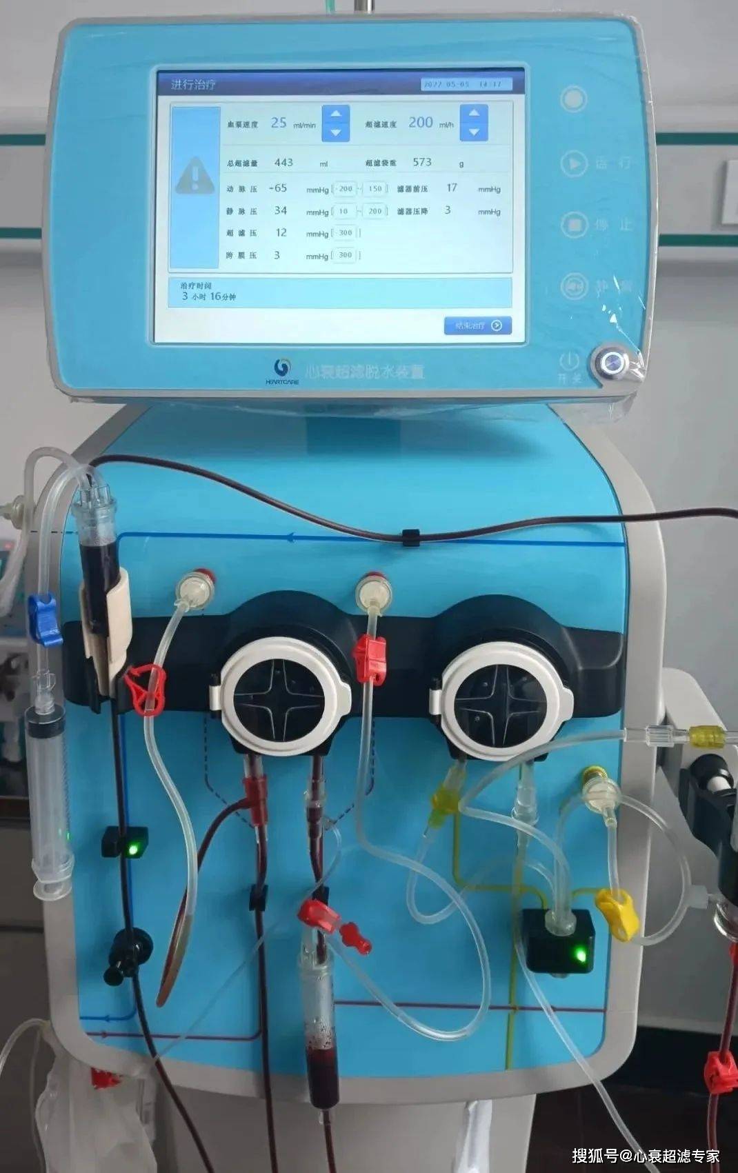 体液潴留的治疗措施,它以血泵驱动为动力,经外周静脉建立体外循环通路