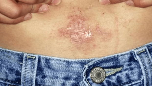 长沙鸿业皮肤专家科普:什么是接触性皮炎_东西_金属_反应