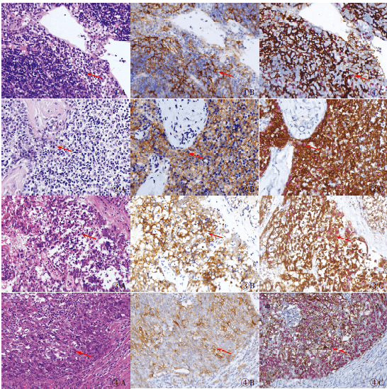 b2 型胸腺瘤he染色; b.pd-l1 免疫組化染色,multimer 法; c.pd-l1