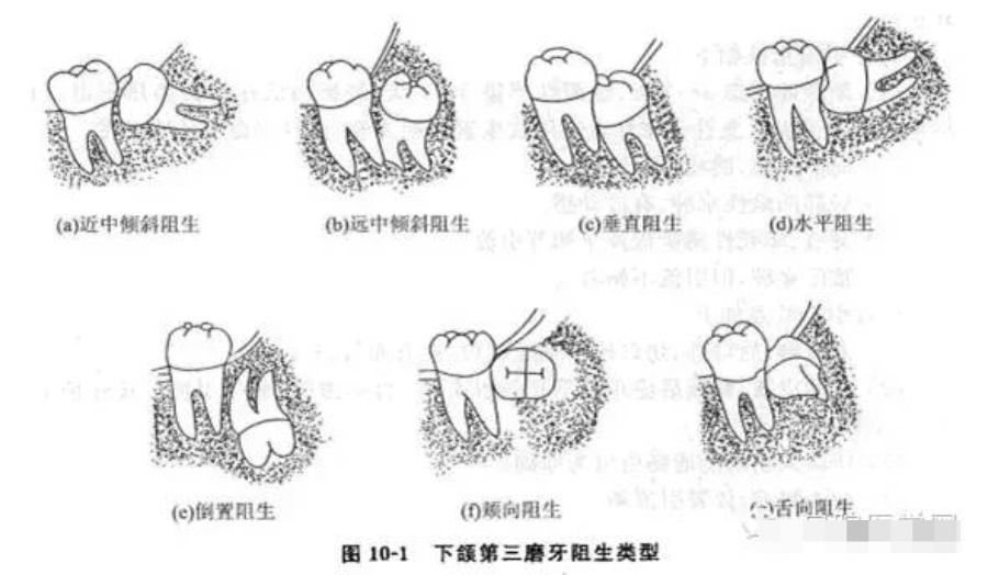 (拔智齒必看)_麻醉_局部_手術