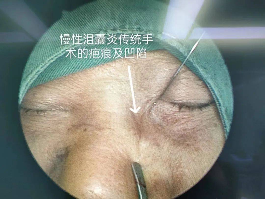 当地眼科医生便按传统经典手术,行"左眼泪囊鼻腔吻合术",但是很遗憾