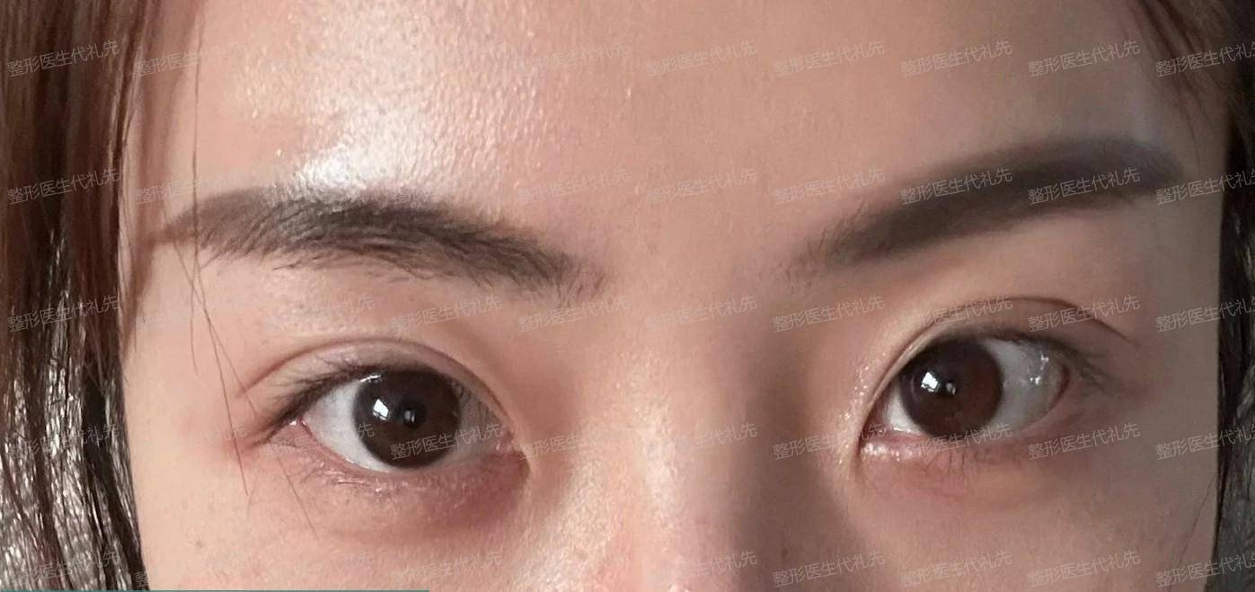 真人案例对比,内切眼袋恢复很快_手术_眼睑_皮肤