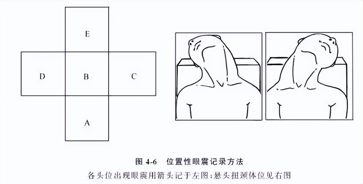 眼震图前庭功能检查图片