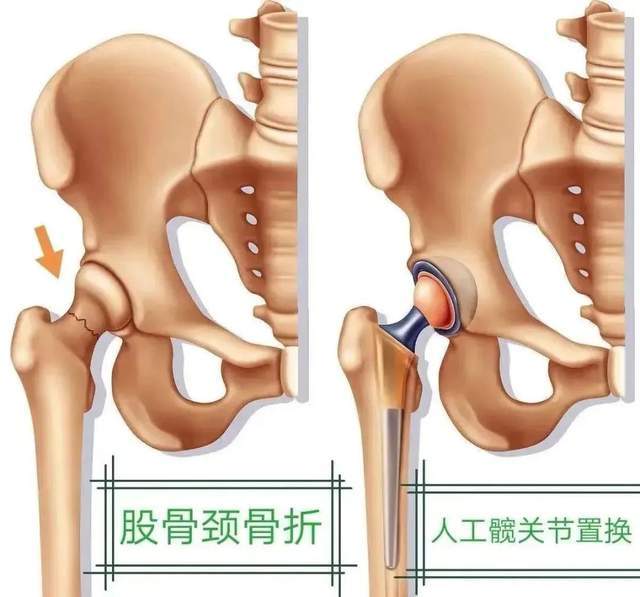 髋关节置换术让75岁老人重走健康路