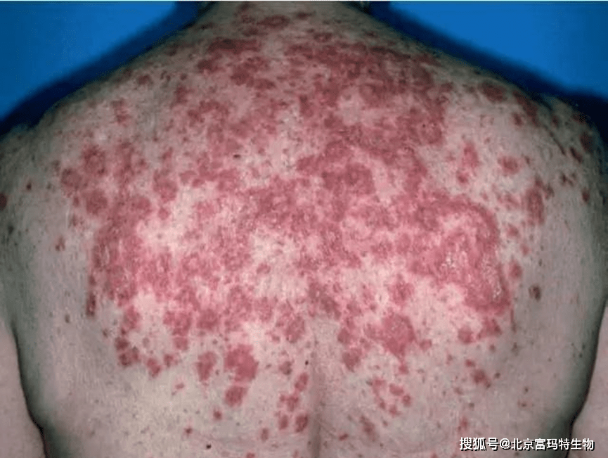 皮肤症状:红斑狼疮最典型的早期表现是蝴蝶状红斑,即双颊对称的红斑