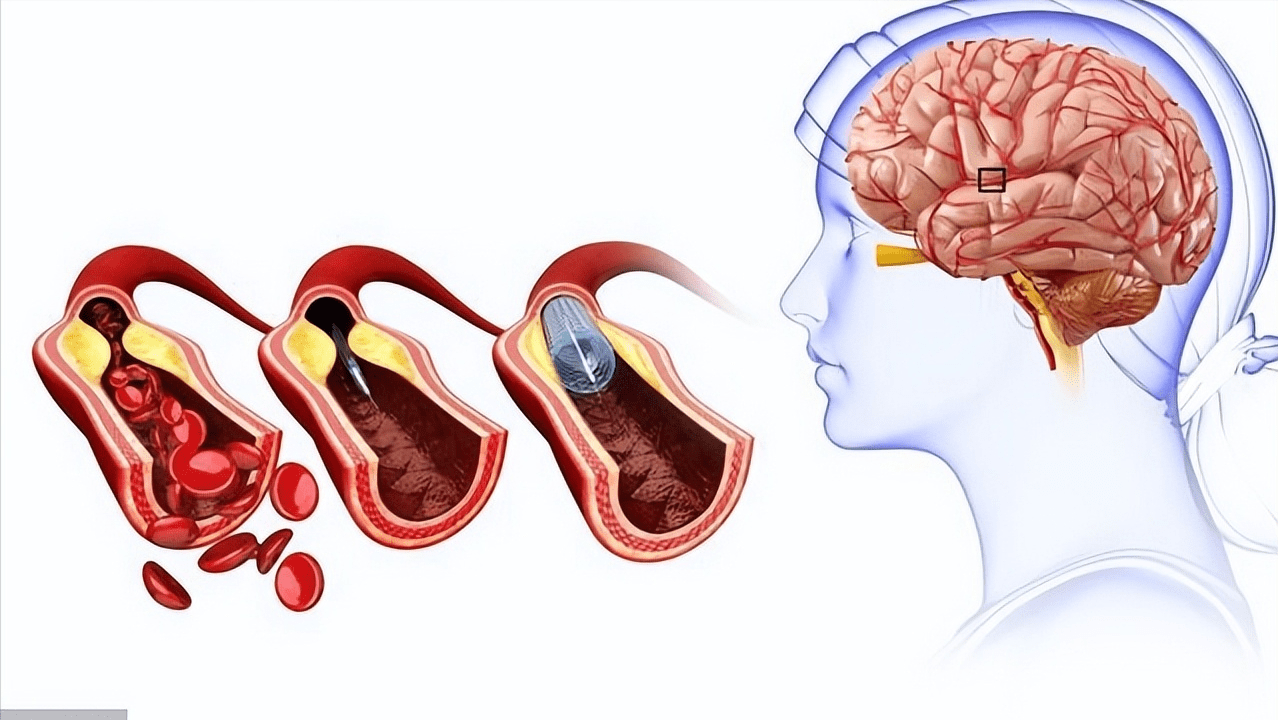 盐竟对大脑血流有惊人影响,科学界揭示令人震惊的发现!