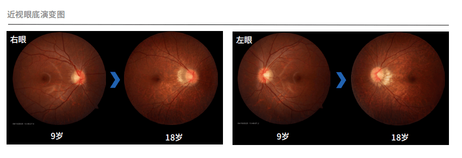 AI视网膜病变检测：开启EarlyDetection新篇章