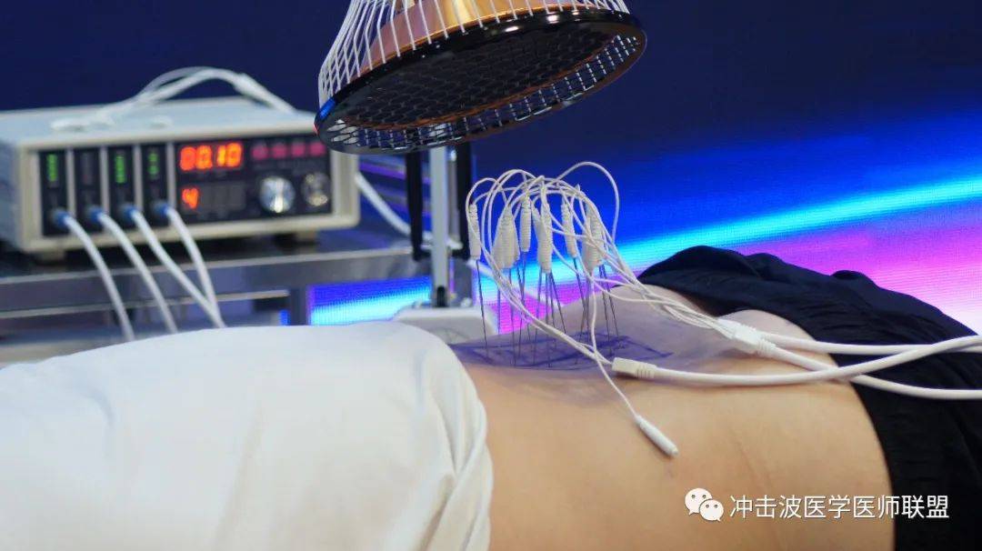 "恒温加热内热针技术"既能治疗疼痛,又能有效防止疾病复发!