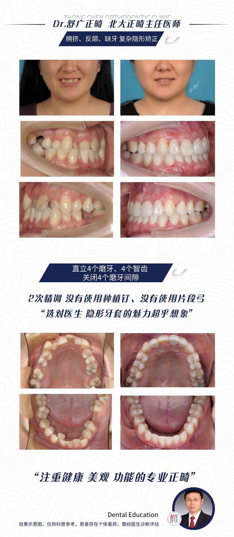 ⑥ 直立4顆磨牙,4顆智齒,關閉4個磨牙間隙的高難度複雜病例,2次精調