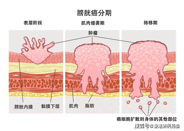 显著生存改善！Padcev联合可瑞达获批用于治疗晚期尿路上皮癌_手机搜狐网