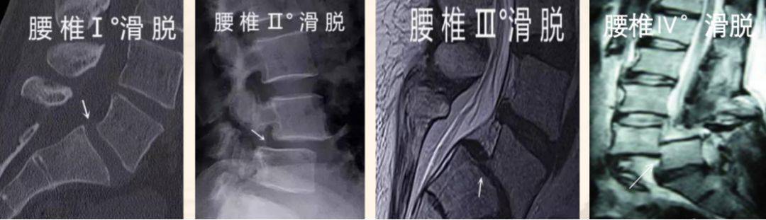 千萬不要忽視腰椎滑脫,造成腰腿痛的主要原因之一_症狀_治療_患者