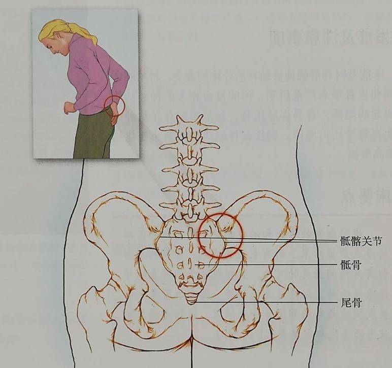 1)腰骶疼痛:疼痛涉及到腰骶部,多為鈍痛,極少數病人可發生嚴重的尾骨