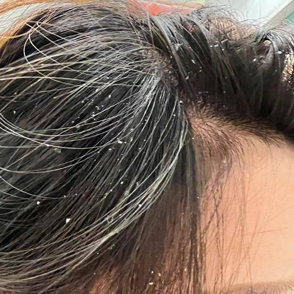 用醋洗头可以止痒去屑吗?止痒去油洗发水推荐