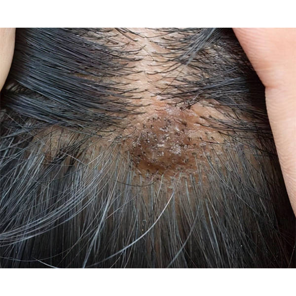 去屑哪个洗发水好用?祛痘止痒洗发水推荐