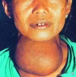 机体因缺碘导致的一系列疾病以前命名为地方性甲状腺肿和地方性克汀病