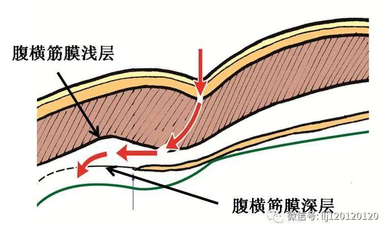 腹腔镜腹股沟疝完全腹膜外疝修补(tep)术后康复注意事项_手机搜狐网