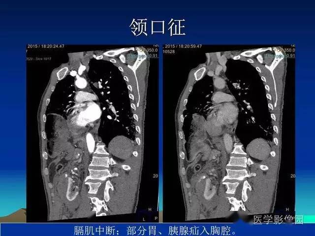 膈疝影像学表现