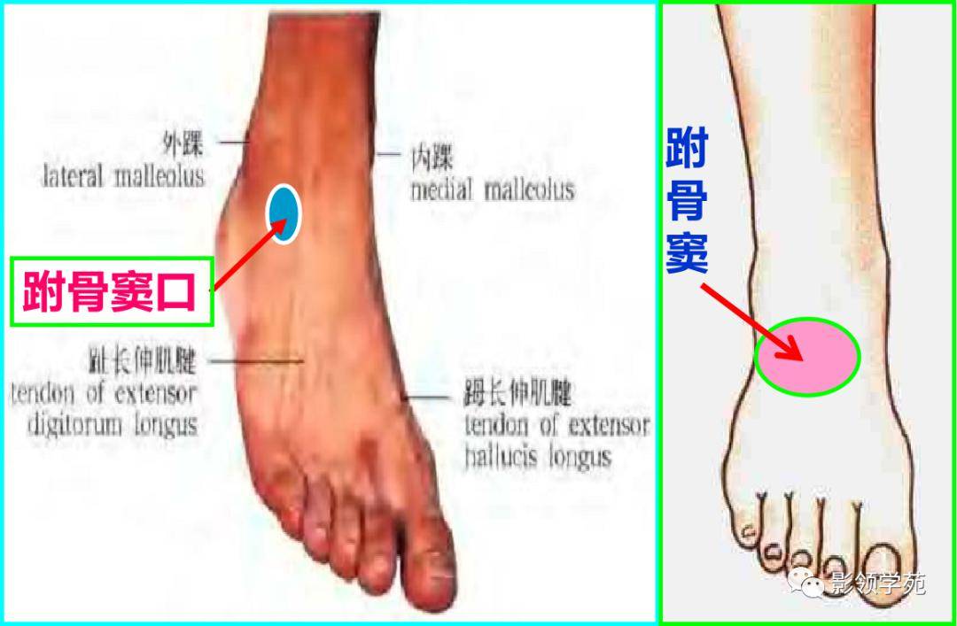 跗骨窦综合征影像诊断