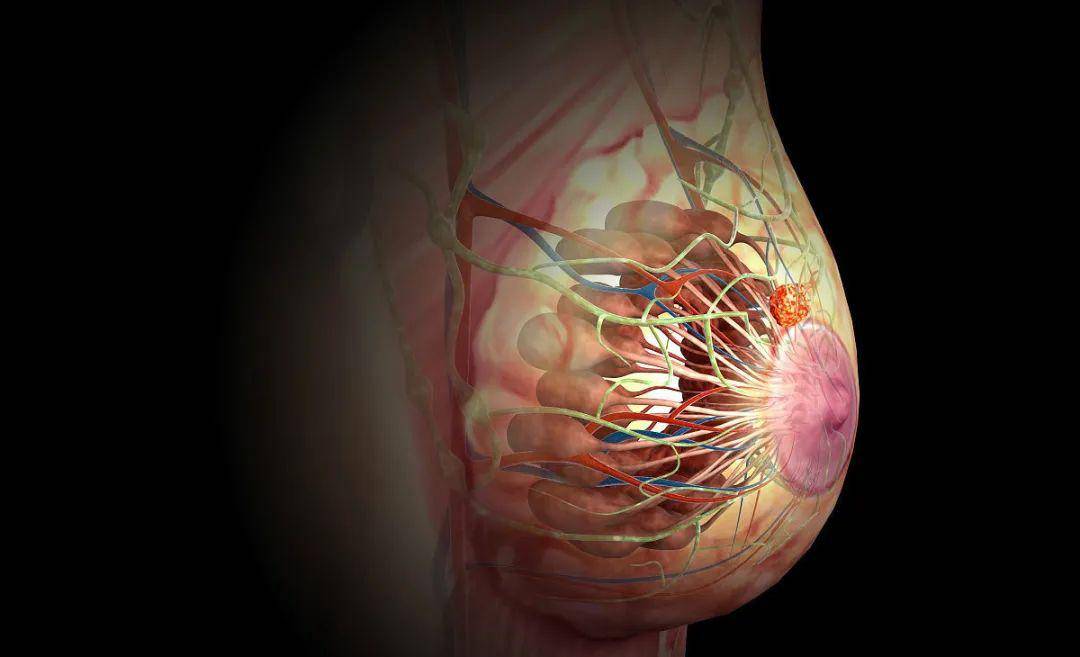 女性得乳腺癌的前兆图片