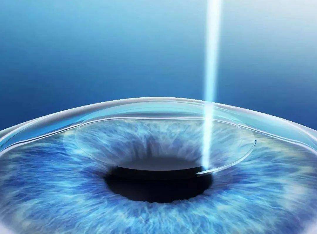 两位白衣天使做完"全飞秒"视力秒变1.2-搜狐大视野-搜狐新闻