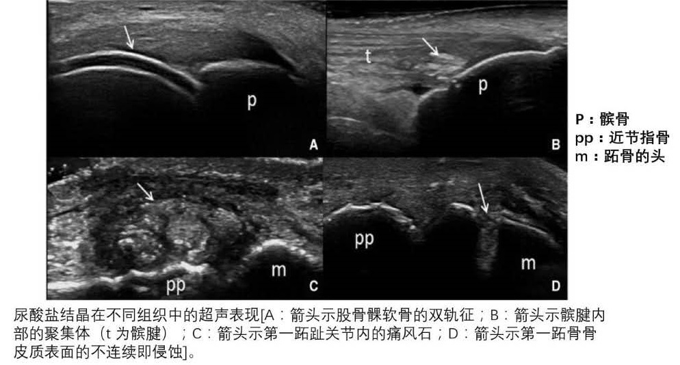 痛风肾超声表现图片