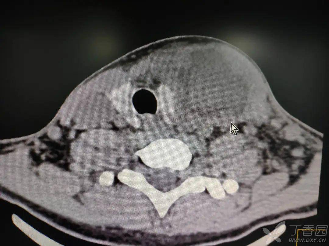 ct 提示左侧颈部巨大脓肿,已至咽后壁,椎旁.