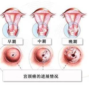 子宫颈癌的早期症状图片