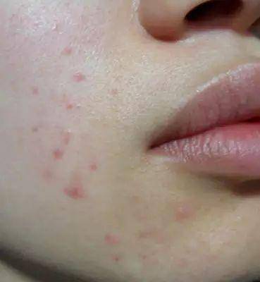 这里长肉粒可不是痘痘那么简单!快看看你脖子上有吗!