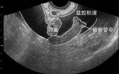 患有阴道炎,宫颈炎时,炎症上行感染,最终也可能导致盆腔炎,形成积液.