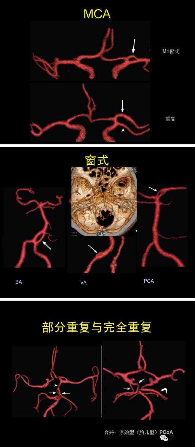 图解脑动脉的正常变异_大脑