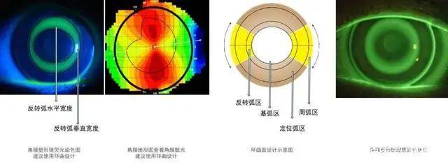 角膜曲率过低的,控制的效果和白天的裸眼视力都会差一些.