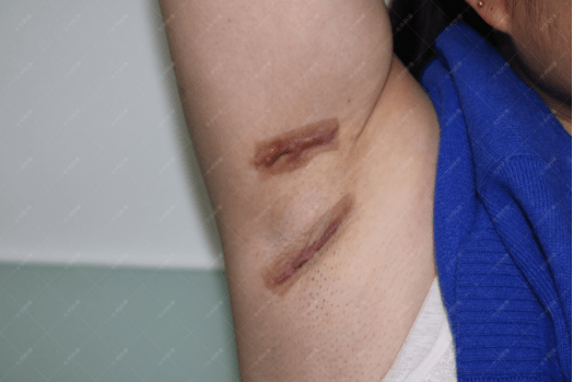 微创狐臭手术刀疤图片图片
