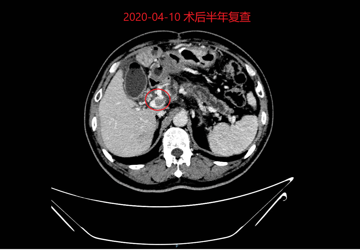 近期再次复查ct及各项指标仍较为稳定,原发肿瘤及门静脉癌栓没有明显