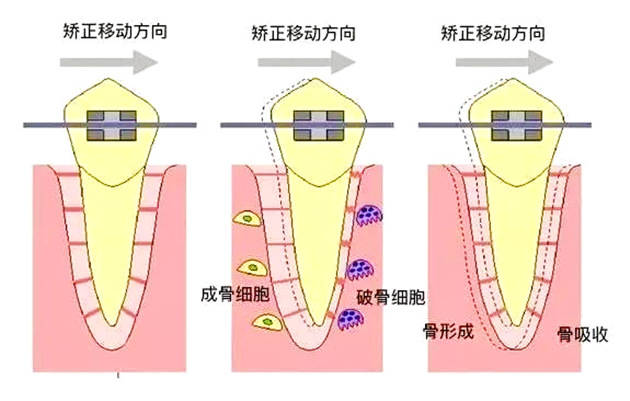 牙槽骨是人体骨骼中代谢,改建最活跃的部分,给它施加一定的外力,它