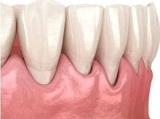 牙周病所引起的牙齿松动当牙齿遭到碰撞或硬物硌伤,咬合创伤等,都能