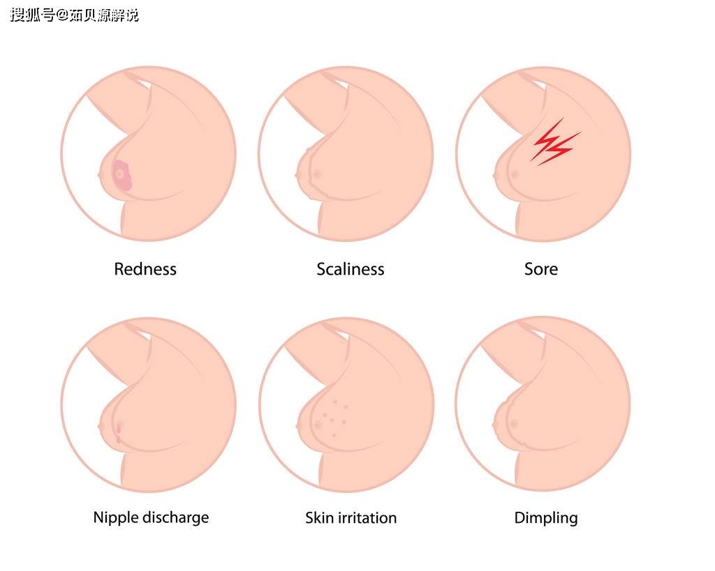 自己怎么检查乳房有结节 71765bd6226b46899c3fa405de57528c.jpeg