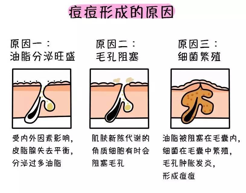 油脂阿澈护肤管家：痘痘不及时护理？小心秒变痘痘肌！